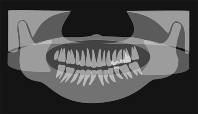 歯のレントゲンのイメージ（＊イラスト：改築工房さん）
