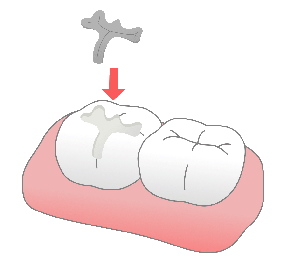 虫歯の治療のイメージ（＊イラスト：hatorinaさん）