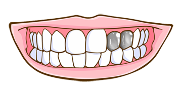 銀歯のイメージ（＊イラスト：レウランさん）