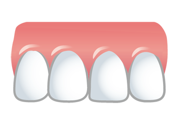 前歯の歯並びのイメージ（＊イラスト：acworksさん）