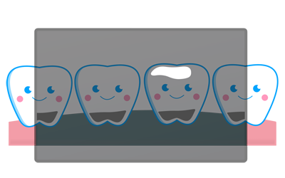 歯のレントゲン写真のイメージ（＊イラスト：あーやんさん）