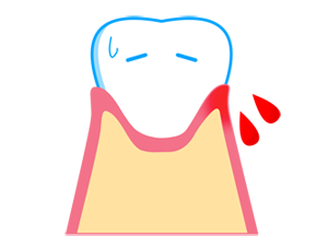 歯ぐきから出血のイメージ（＊イラスト：あーやんさん）