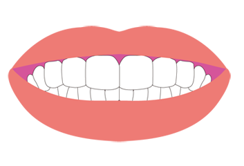 歯並びのイメージ（＊イラスト：えーしーさん）