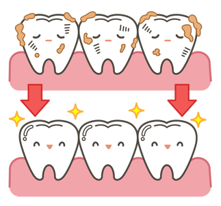 歯のクリーニングのイメージ（＊イラスト：バターさん）