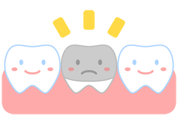 奥歯の銀歯のイメージ（＊イラスト：ジョウモンさん）